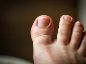 Tå med tånegl klippet for kort, eksempel på feil ved riktig neglekliping